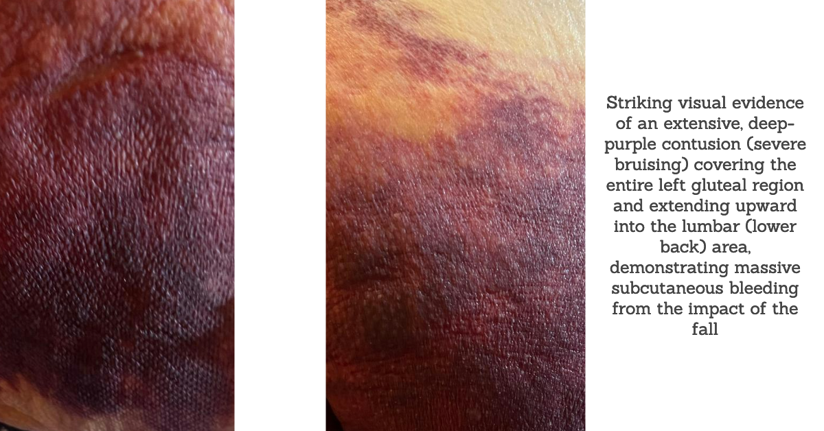 buttock bruising